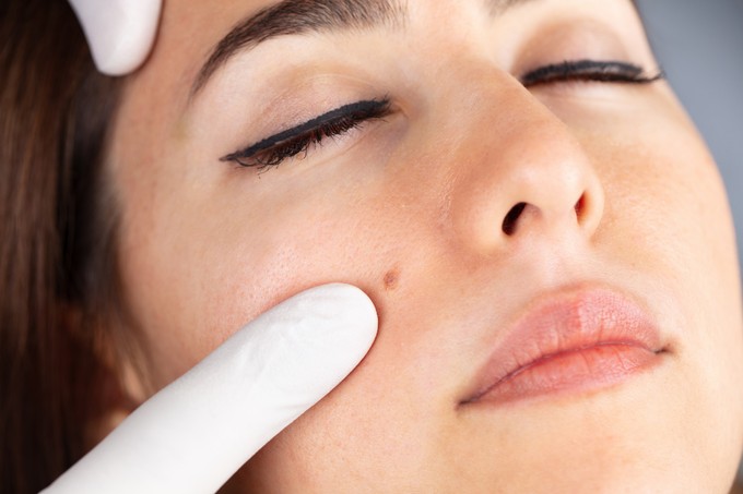 Eltávolítható az arcon lévő anyajegy hegesedés nélkül? című cikk nyitóképe