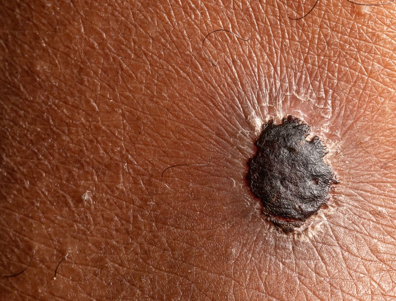 melanoma első jelei