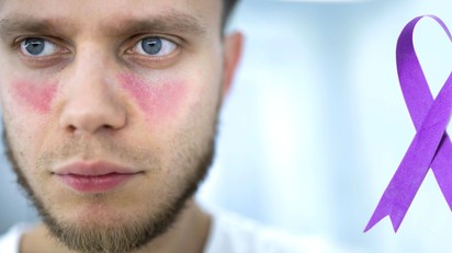 A lupus első jelei: ezeket a tüneteket sokan hónapokig figyelmen kívül hagyják című cikk nyitóképe