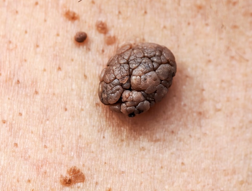 melanoma bőrrák tünet anyajegy elváltozás