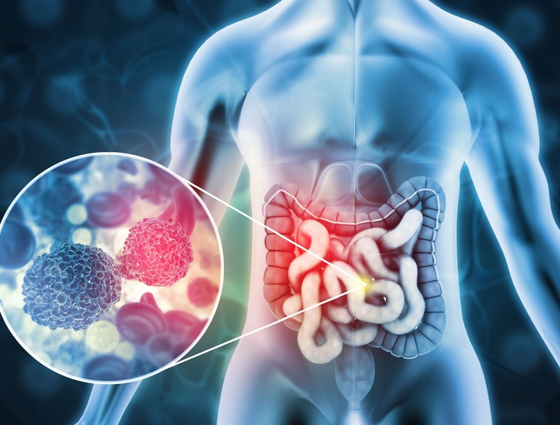 Vastagbélrák, végbélrák ellen oka, vöröshús, dohányzás életmód