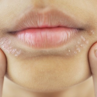 Az immunrendszer néha téved, és nem kér elnézést – ezt üzeni a bőr az ételallergiáról című cikk nyitóképe