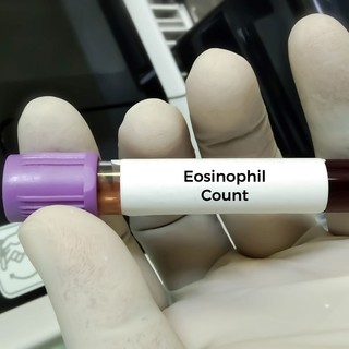 Mitől lehet magas a eosinophil a vérképben? Ezeket mindenképp tudnia kell! című cikk nyitóképe