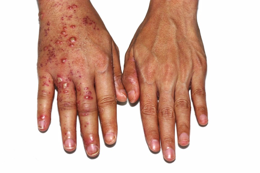 A bőr fertőzését okozó két herpesz szimplex vírus a HSV-1 és a HSV-2.