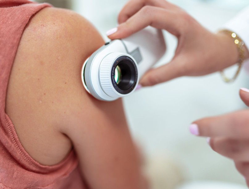 basalioma bőrdaganat bőrrák anyajegyszűrés