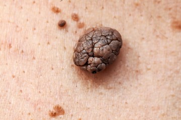 Bőrrák tünetek: ezek az elváltozások lehetnek gyanúsak az anyajegyeken