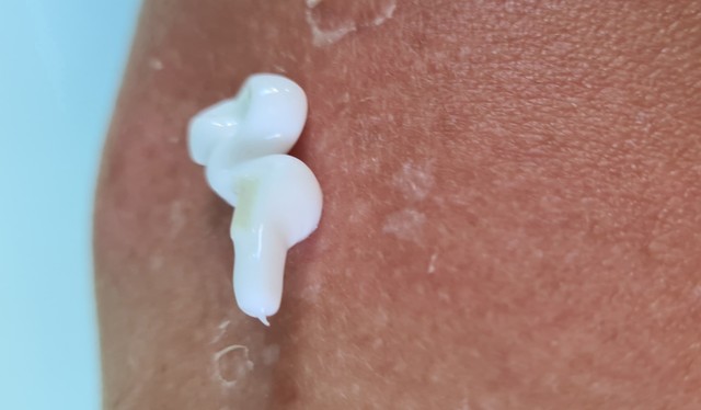 Ha legyengül a szervezete, nagyobb eséllyel támadják meg a bőrét ezek a gombák