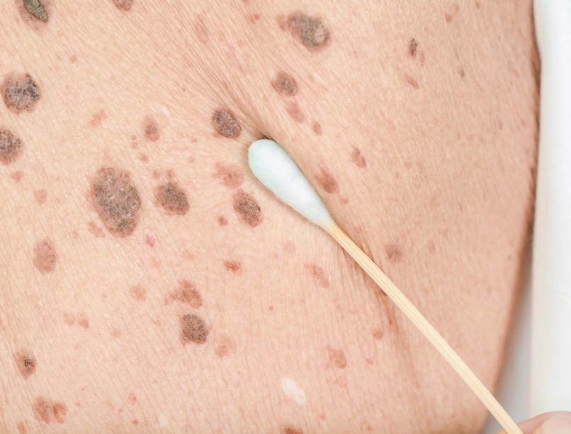 májfolt oka bőrön hormonális betegség tünete