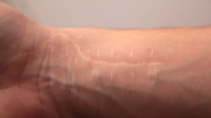 Meglepő, de a seb nem felejt! Egy régi heg is okozhat derékfájást, székrekedést, vagy akár meddőséget című cikk nyitóképe