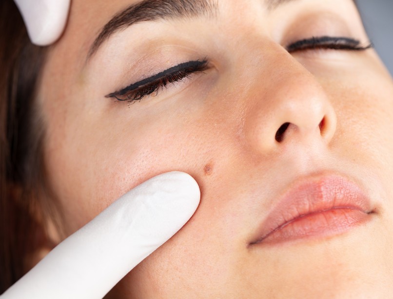 anyajegyszűrés eétávolítás heg