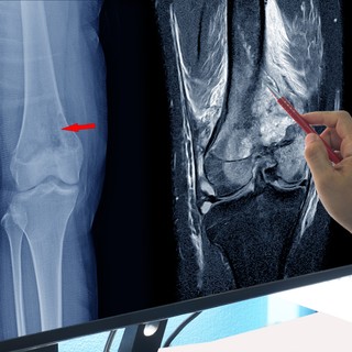 Oszteoszarkóma című cikk nyitóképe