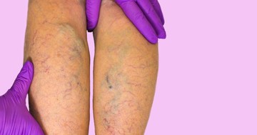  Visszeres a kismama: kell véralvadásgátlás terhesség idején? 