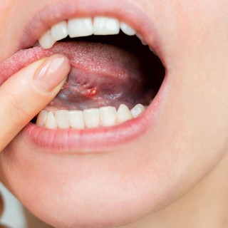 A nyelve is árulkodhat: 9 szájüregi tünet, amely B12-vitamin-hiányra figyelmeztethet című cikk nyitóképe