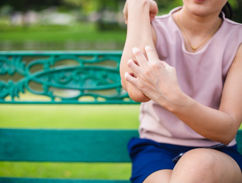 napallergia, napégés, melanóma, bőrrák