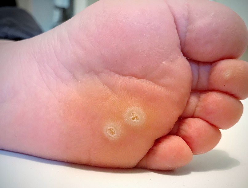 bőrkeményedés tyúkszem ellen természetes kezelés