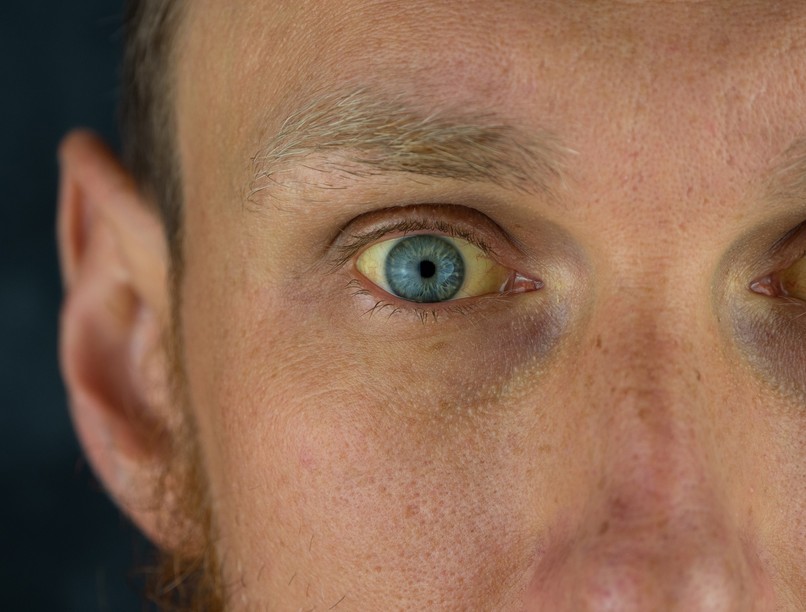 hepatitis a májgyulladás vírus szlovákia