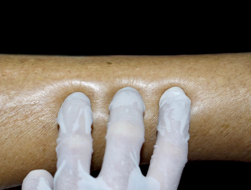 Ödéma végtagokon oedema extremitatum tünet