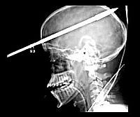 Orvosi bravúr: a szigonnyal átfúrt fejű fiú megmentése