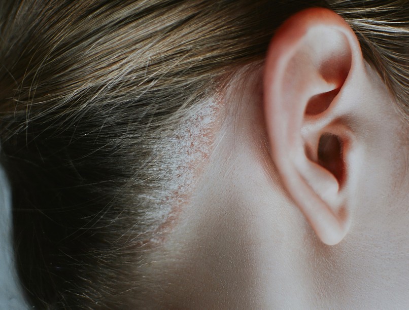 pikkelysömör kezelése hámlás viszketés