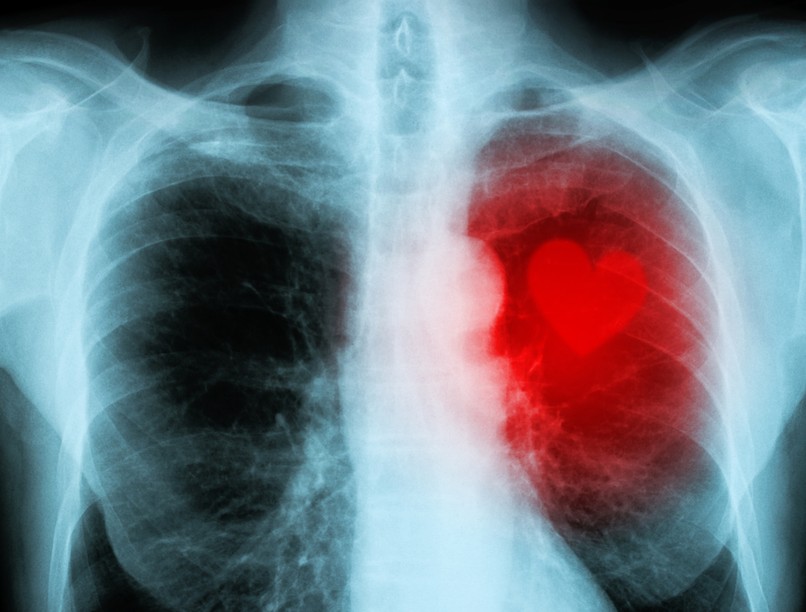 szívizomgyulladás, myocarditis, covid, oltás, mrns, vakcina, Pfizer, Moderna
