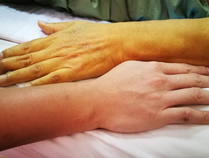 Mi a sárgaság icterus tünet