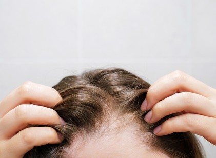 Mitől hullik a hajam? Gyakori okok, amikre kevesen gondolnak című cikk nyitóképe