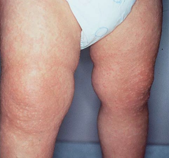 Az ilyen típusú elváltozások diagnosztizálása és kezelése mindenképpen szakorvos feladata. 