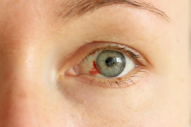 Bevérzés a szemen: ekkor érdemes trombózisra gyanakodni!