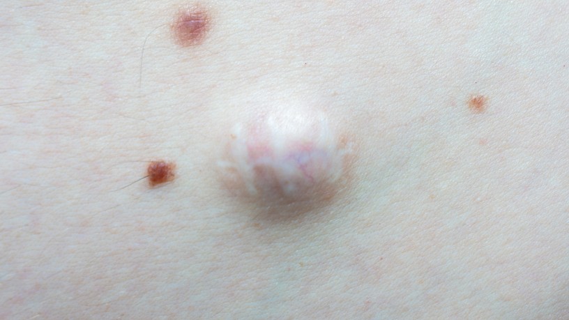 bőrkiütés, atheroma, zsirmirgy