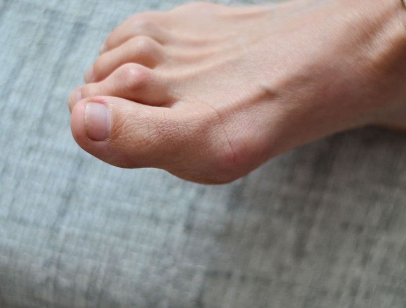 kalapácsujj lábfej izom egyensúly fizikoterápia