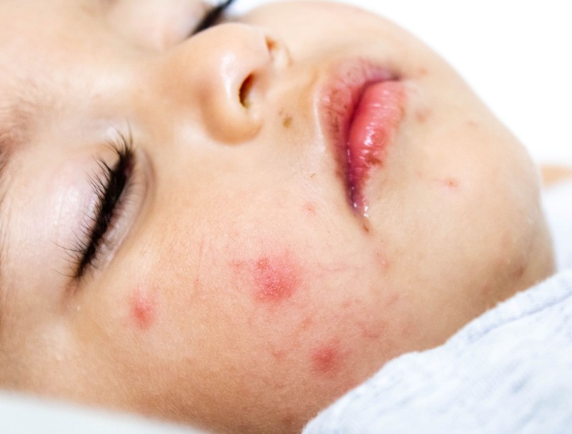 fájdalmas hólyagok szájban fertőzés tünete