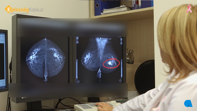 emlőrák, mammográfia, mellrág, daganatos betegségek, szűrővizsgálat