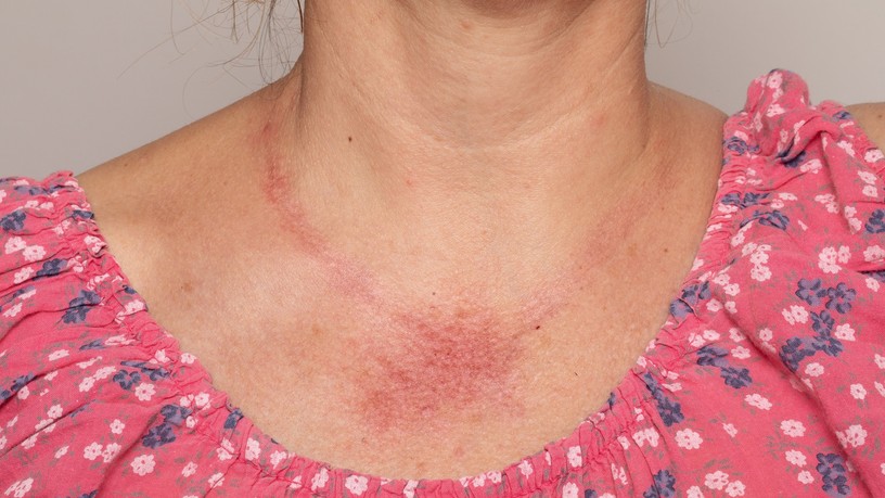 bőrpír erythema tünet bőrtünet