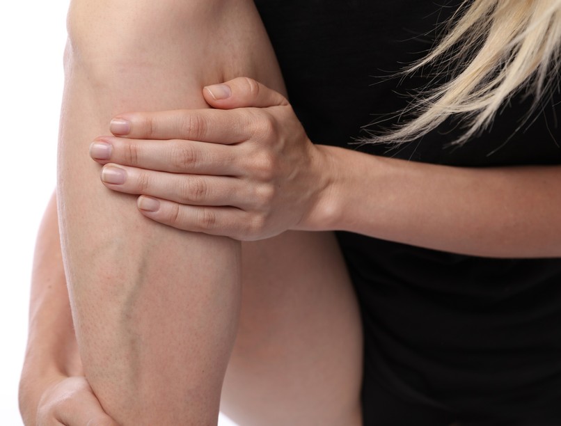 visszerek hajszálerek láb visszér betegség