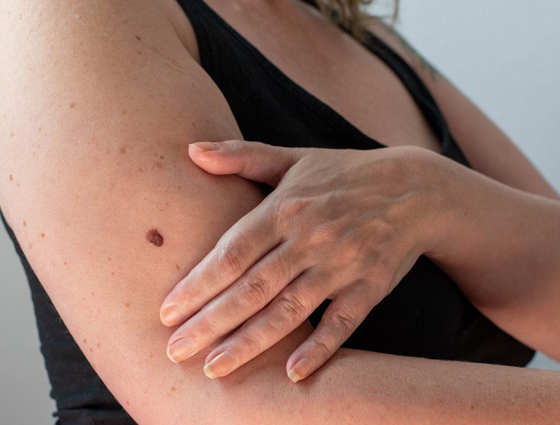 bőrrák, megelőző, bőrgyógyász, anyajegy, melanóma