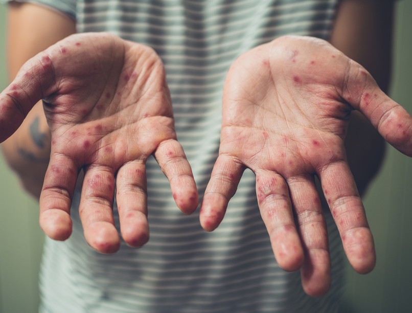 bárányhimlő, gyerek, tünet, jel