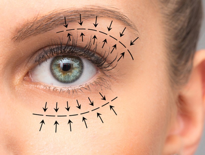 szemhéj, szemhéjplasztika, szemész, látás, esztétikai sebészet, blepharoplasztika