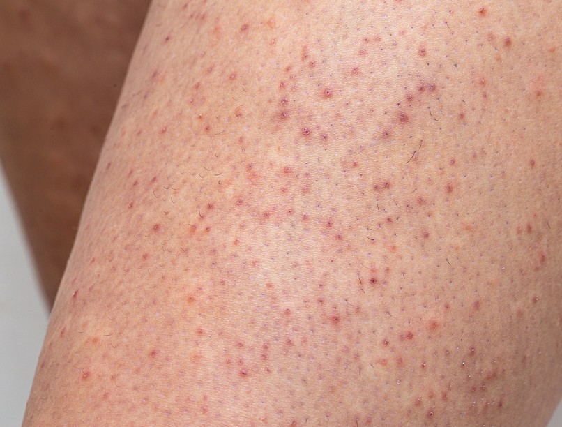 szőrbenövés, gyulladás, ellen orvos válaszol