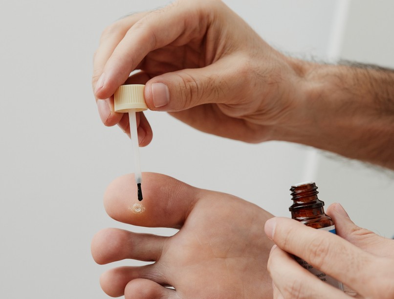 Szemölcs ellen házilag otthon módszer