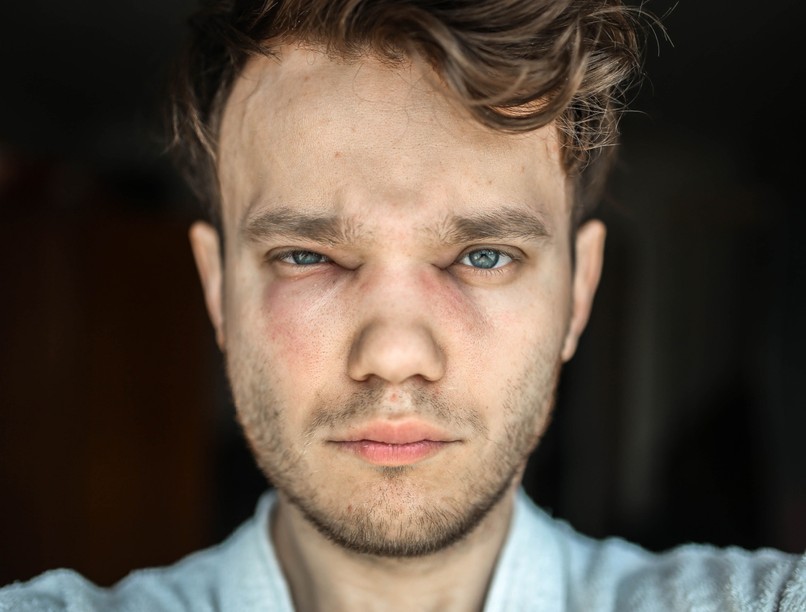 Duzzad szem, légszomj oka angioödéma