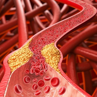 Magas koleszterinszint ellen mit együnk és mit ne? Dietetikus mondja el, mit kerüljön című cikk nyitóképe