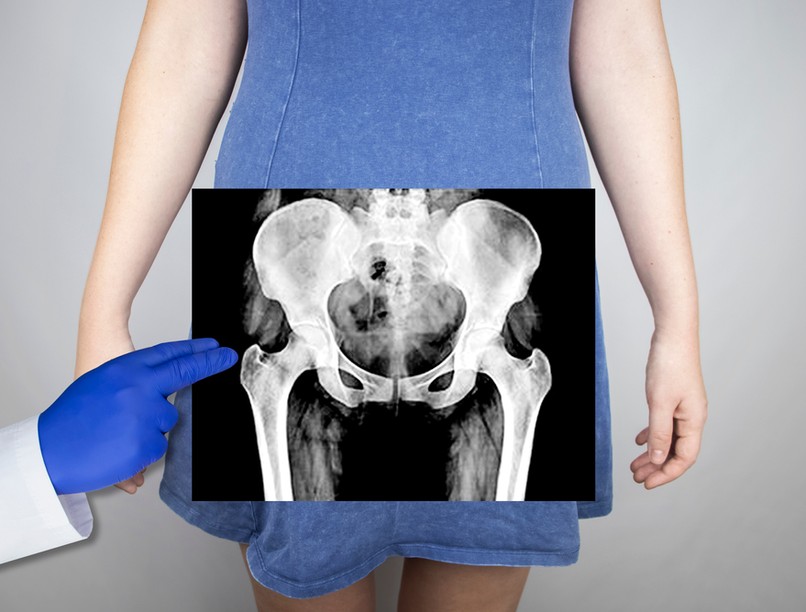  kalcium-foszfát, csont, csontok, izmok, erek, kalcium, ásványi anyag 