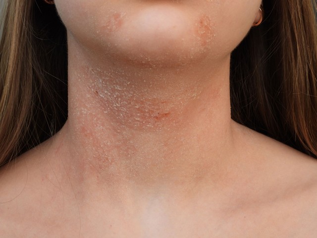 Mi okozza az atópiás dermatitiszt és hogyan kezelhető? Erről jó, ha tud!