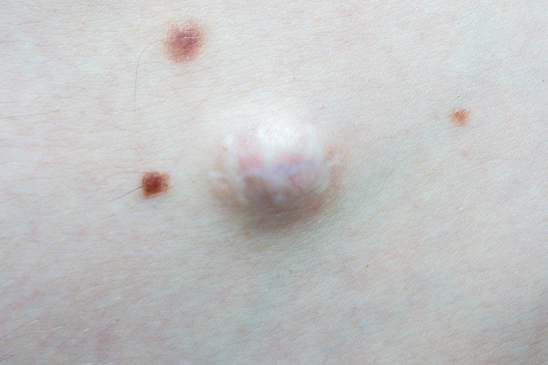 Mi az az atheroma, és mikor kell műteni?