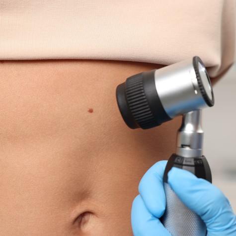 Veszélyes anyajegyek: 5 jel, ami miatt azonnal bőrgyógyászhoz kell fordulni című cikk nyitóképe