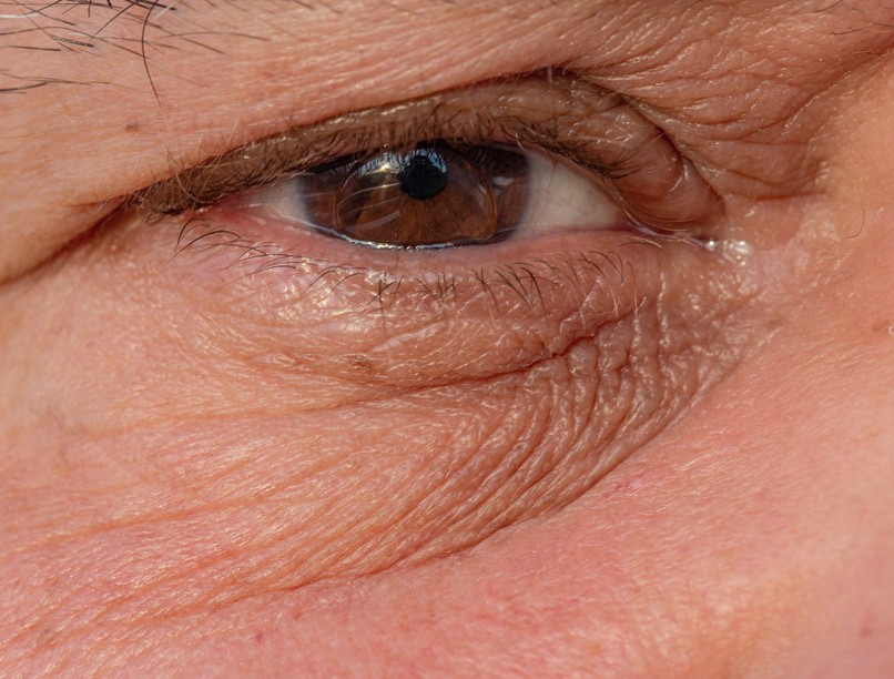 csüngő szemhéj, ciszta, oka, jele