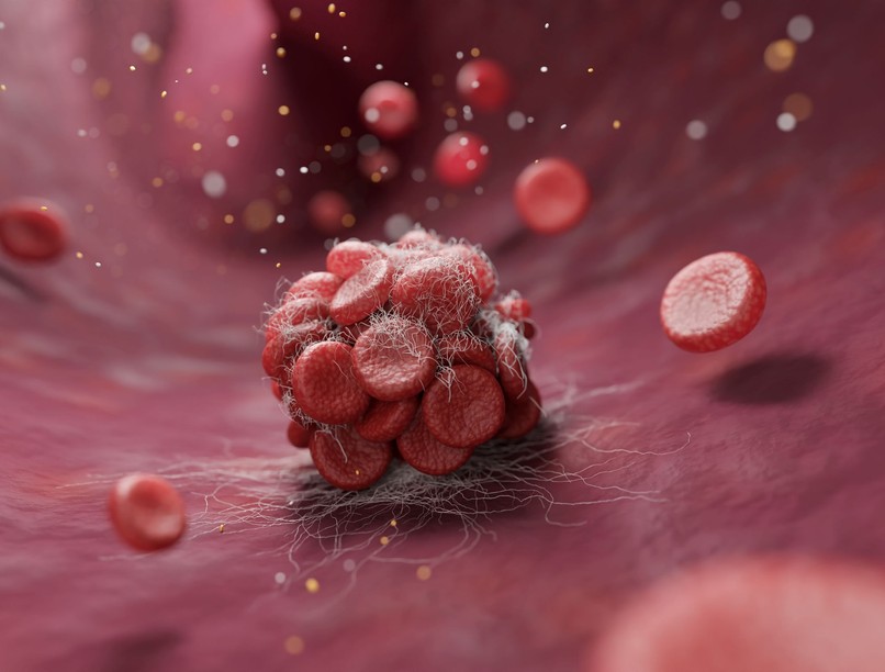 trombózis vérrög ellen mozgás