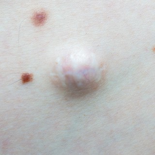 Mi az az atheroma, és mikor kell műteni? című cikk nyitóképe