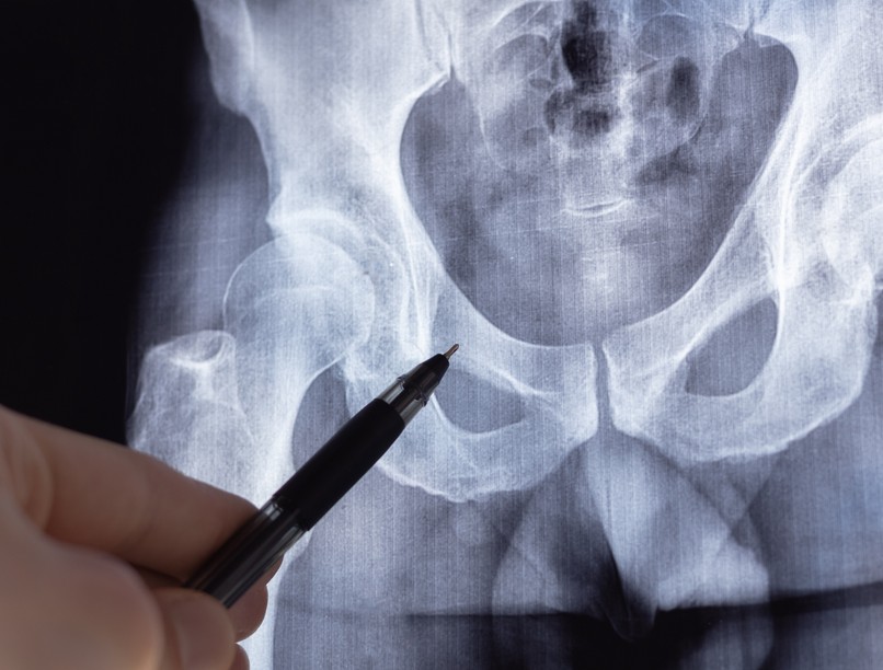 törékeny csontok ellen időskor