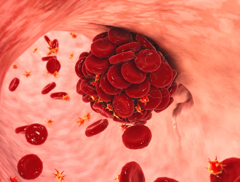 koronavírus, covid-19, aspirin, aszpirin, acetilszalicilsav, vérhígító, tombózis, vérrög